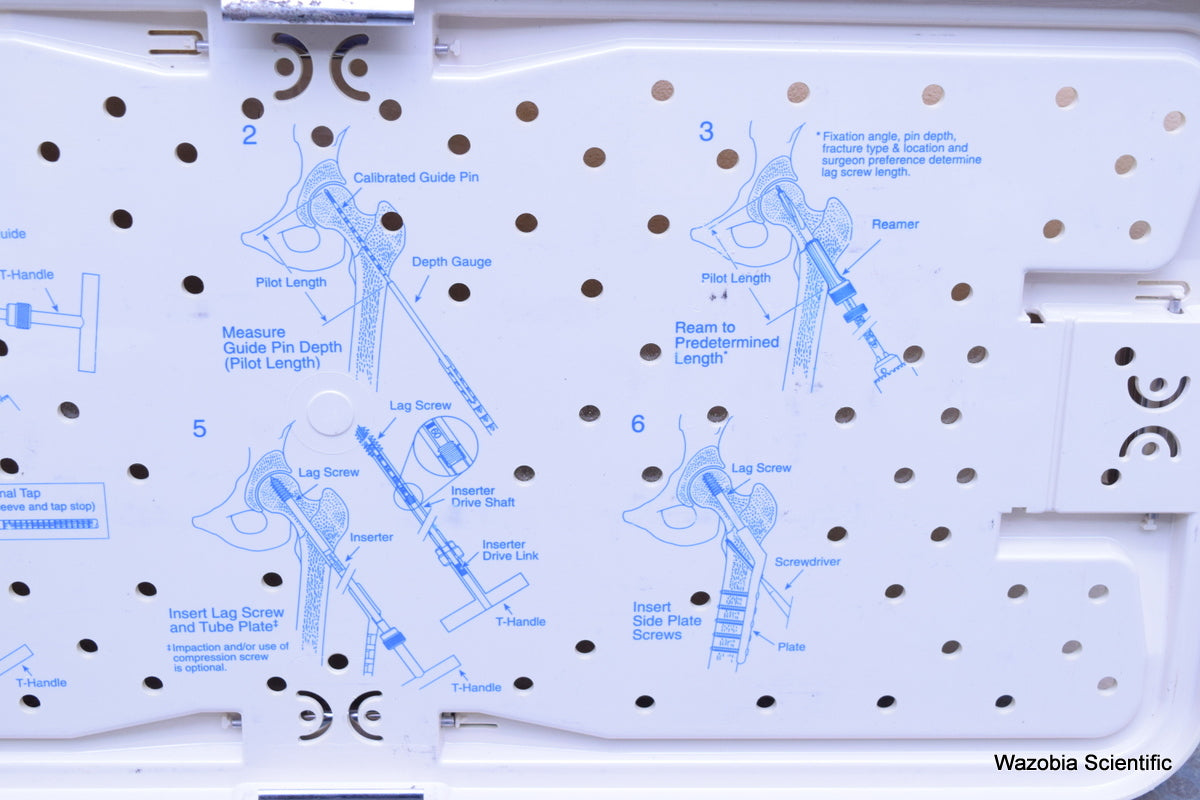 ZIMMER VERSA-FX II FEMORAL FIXATION SYSTEM  FRACTURE MANAGEMENT